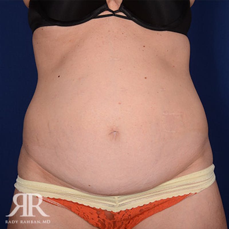 Tummy Tuck Before & After Gallery - Patient 249047 - Image 1