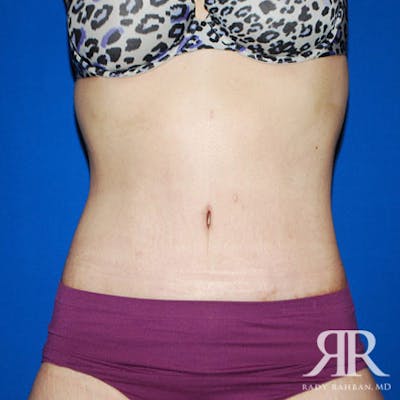 Body Lift Before & After Gallery - Patient 780258 - Image 2
