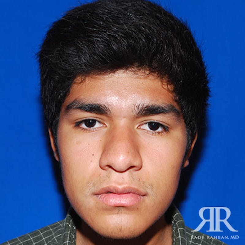 Ethnic Rhinoplasty Before & After Gallery - Patient 144472 - Image 1