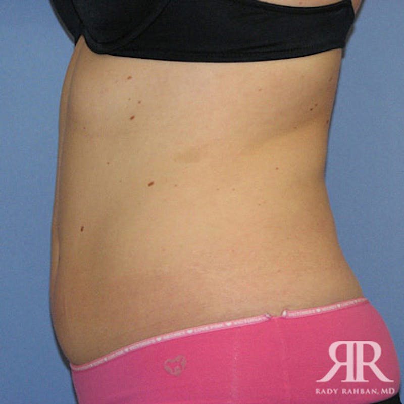 Liposuction Before & After Gallery - Patient 880408 - Image 4