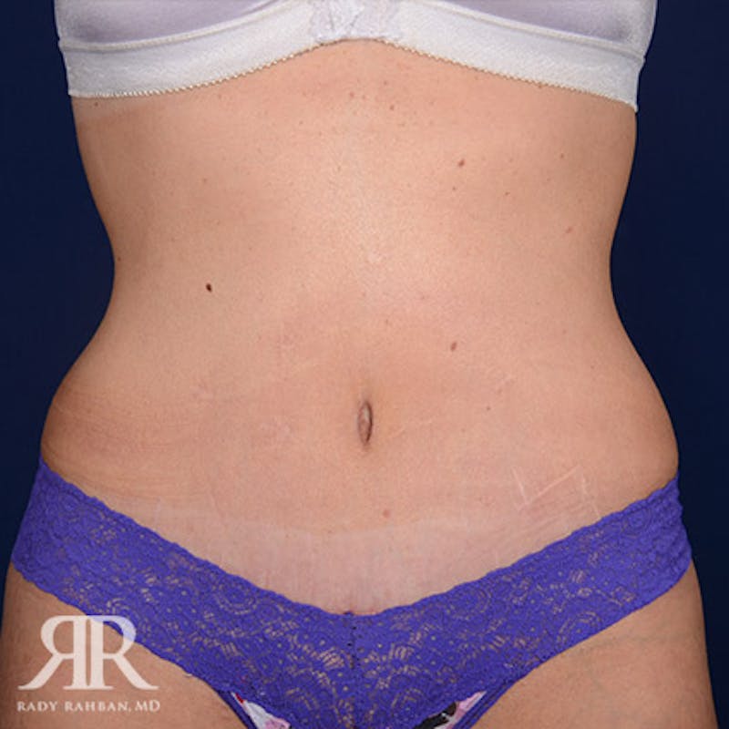 Before and after patient results