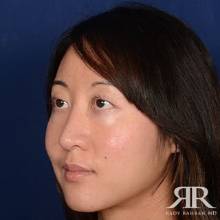 Female Rhinoplasty Before & After Gallery - Patient 270467 - Image 4