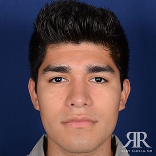 Ethnic Rhinoplasty Before & After Gallery - Patient 144472 - Image 2