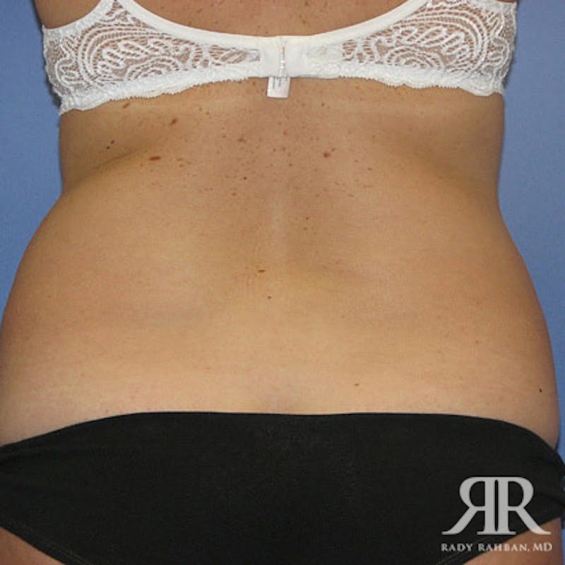 Liposuction Before & After Gallery - Patient 880408 - Image 5