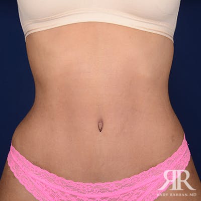 Severe Diastasis Recti Before & After Gallery - Patient 394234 - Image 2