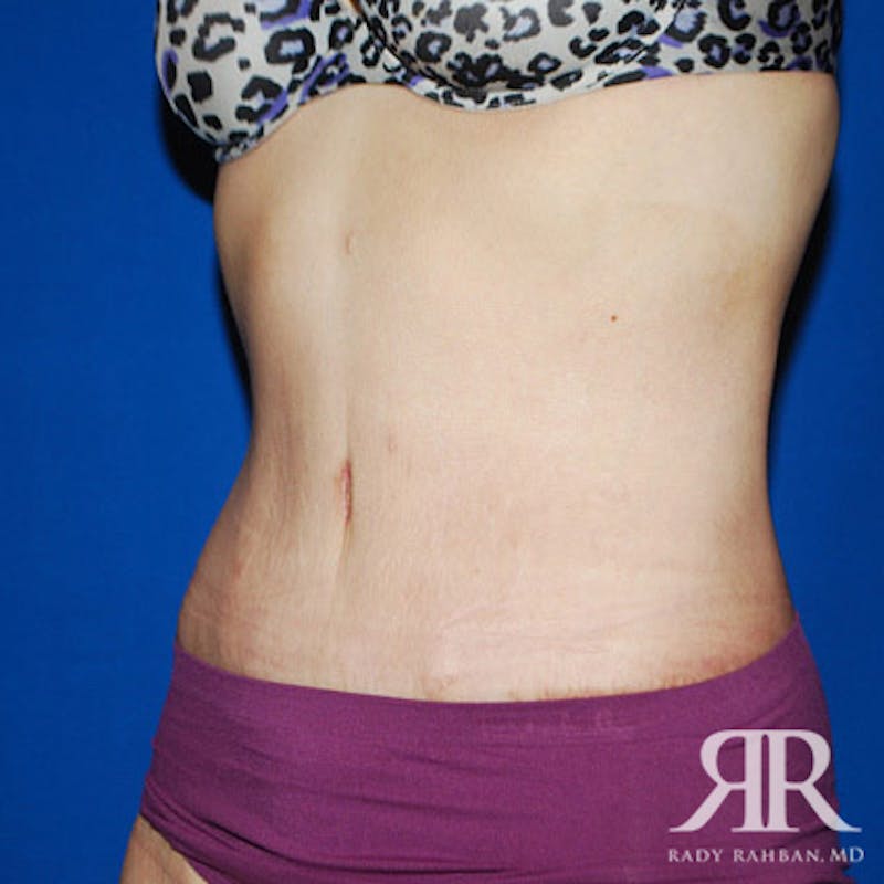 Body Lift Before & After Gallery - Patient 780258 - Image 4