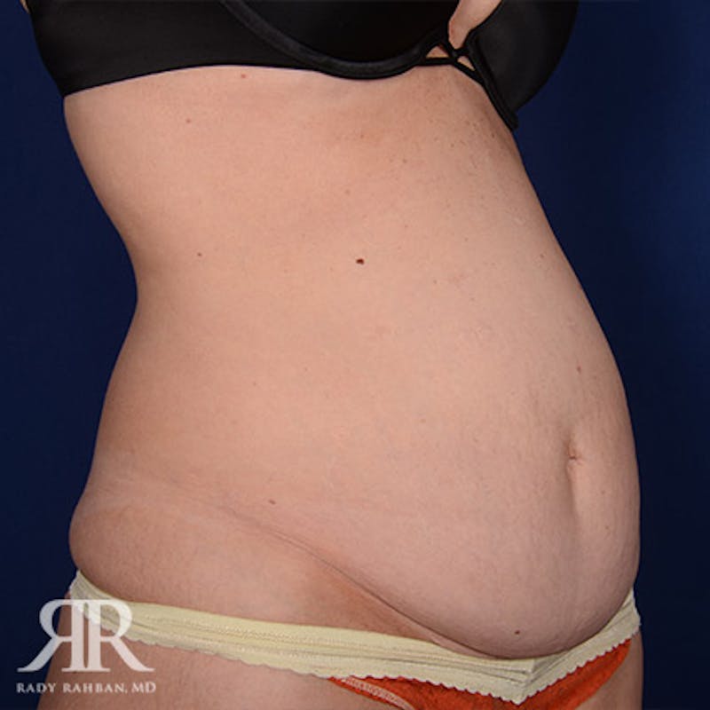 Tummy Tuck Before & After Gallery - Patient 249047 - Image 3