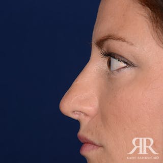 Corrective / Revision Rhinoplasty Before & After Gallery - Patient 224330 - Image 8
