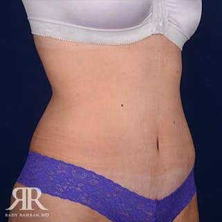 Tummy Tuck Before & After Gallery - Patient 249047 - Image 4