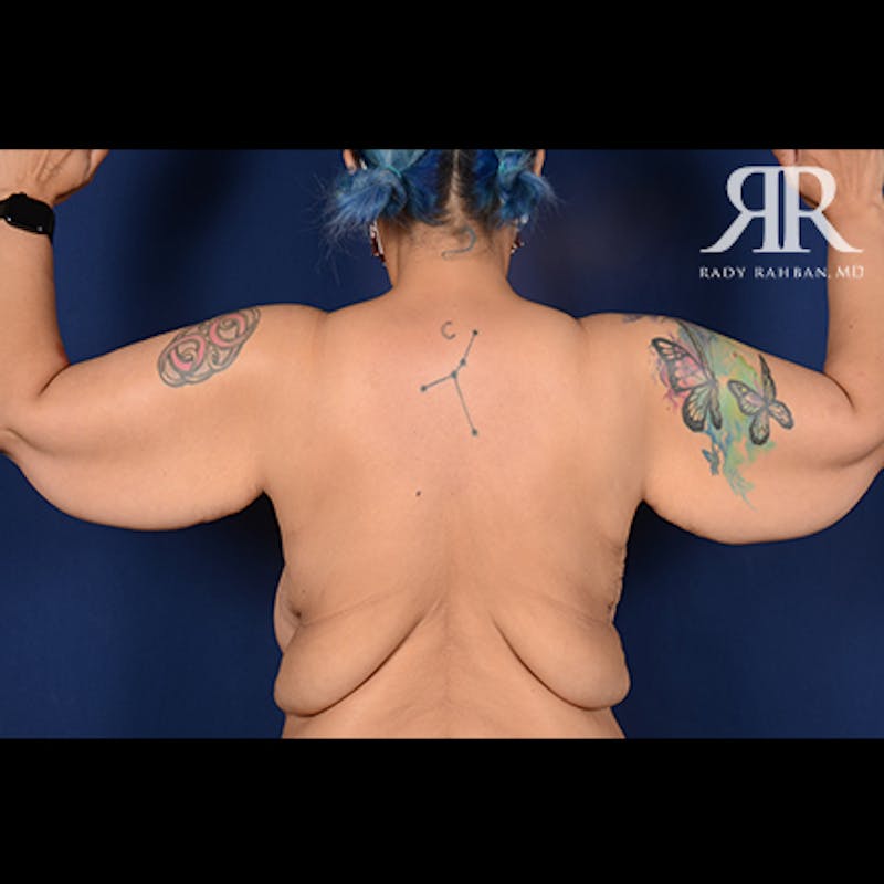 Arm Lift Before & After Gallery - Patient 702994 - Image 1