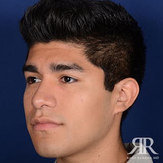 Ethnic Rhinoplasty Before & After Gallery - Patient 144472 - Image 4