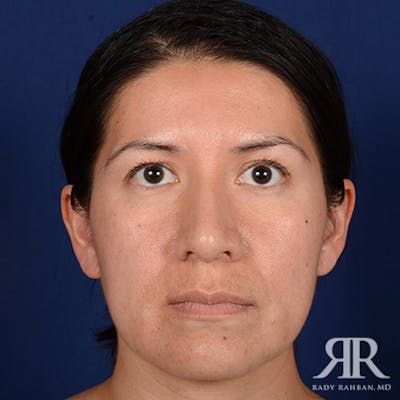 Corrective / Revision Rhinoplasty Before & After Gallery - Patient 115295 - Image 1