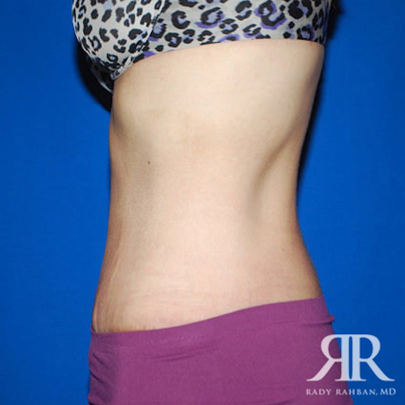 Body Lift Before & After Gallery - Patient 780258 - Image 6