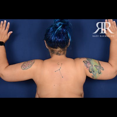 Arm Lift Before & After Gallery - Patient 702994 - Image 2