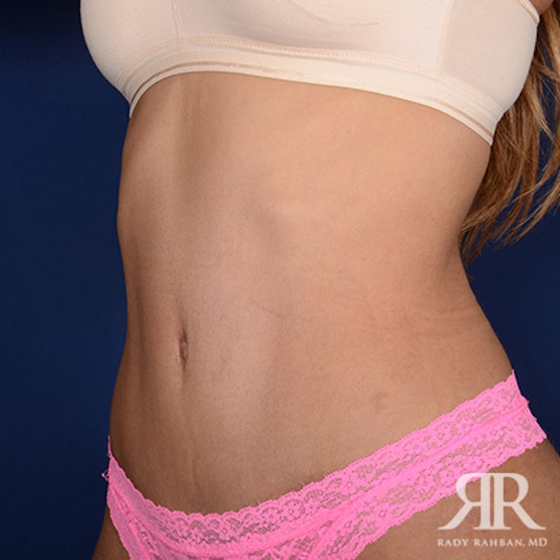 Severe Diastasis Recti Before & After Gallery - Patient 394234 - Image 4