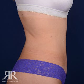 Tummy Tuck Before & After Gallery - Patient 249047 - Image 6
