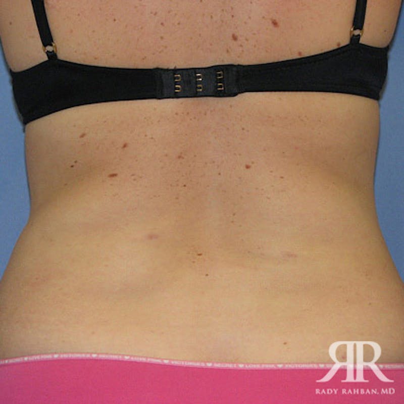 Liposuction Before & After Gallery - Patient 880408 - Image 6