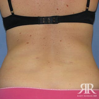 Liposuction Before & After Gallery - Patient 880408 - Image 6