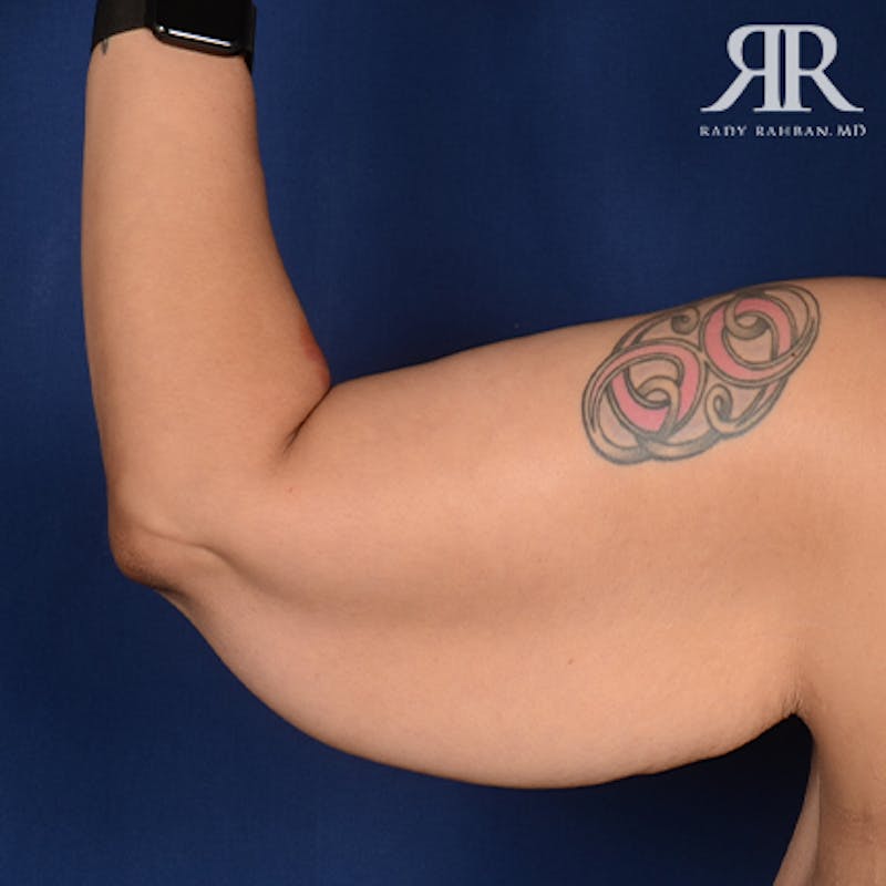 Arm Lift Before & After Gallery - Patient 702994 - Image 3