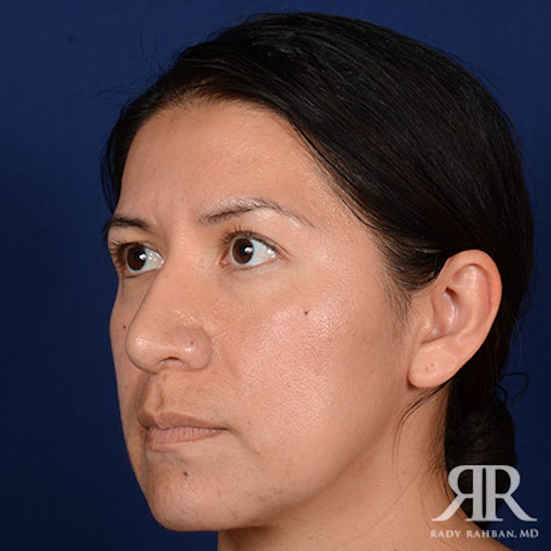 Corrective / Revision Rhinoplasty Before & After Gallery - Patient 115295 - Image 3
