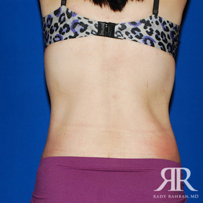 Body Lift Before & After Gallery - Patient 780258 - Image 8