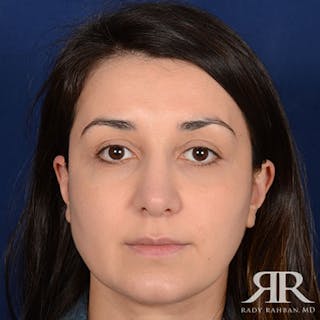 Female Rhinoplasty Before & After Gallery - Patient 140417 - Image 2