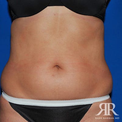 Liposuction Before & After Gallery - Patient 975469 - Image 1