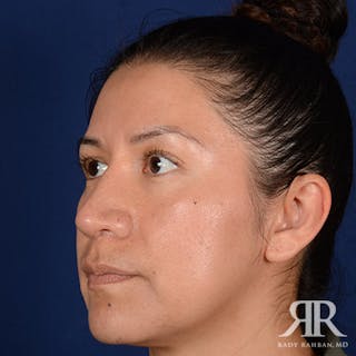 Corrective / Revision Rhinoplasty Before & After Gallery - Patient 115295 - Image 4