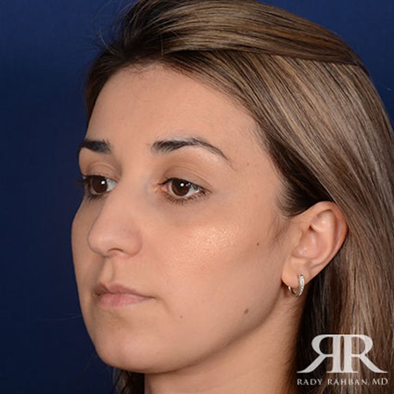 Female Rhinoplasty Before & After Gallery - Patient 140417 - Image 3
