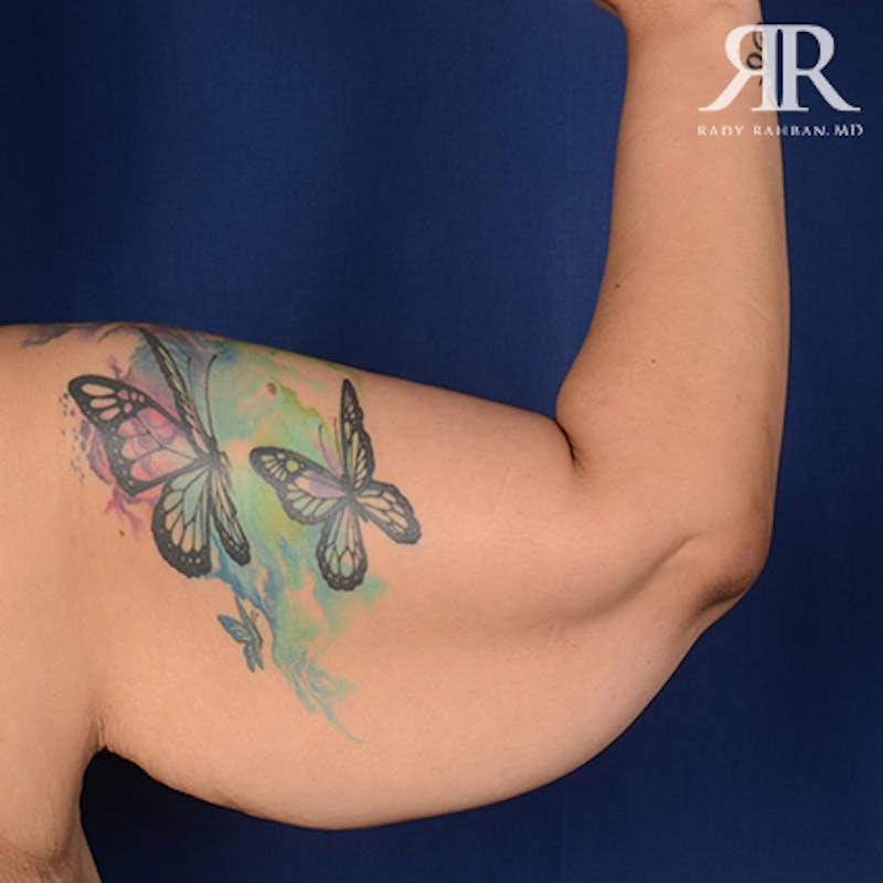 Arm Lift Before & After Gallery - Patient 702994 - Image 5