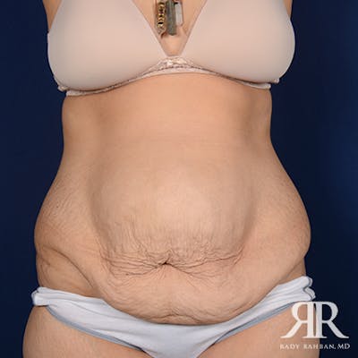 Severe Diastasis Recti Before & After Gallery - Patient 274376 - Image 1