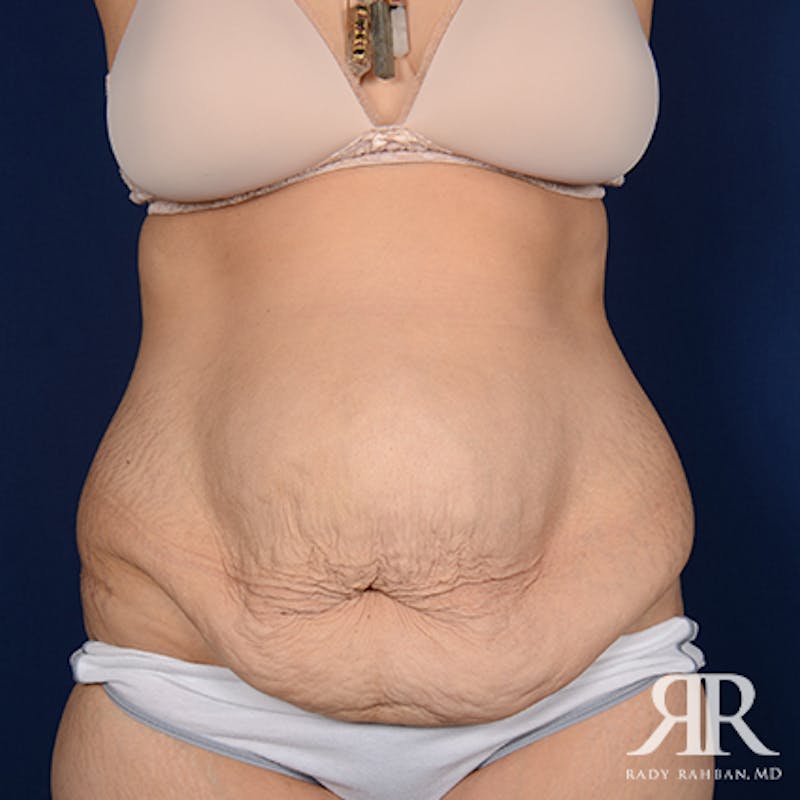 Severe Diastasis Recti Before & After Gallery - Patient 274376 - Image 1