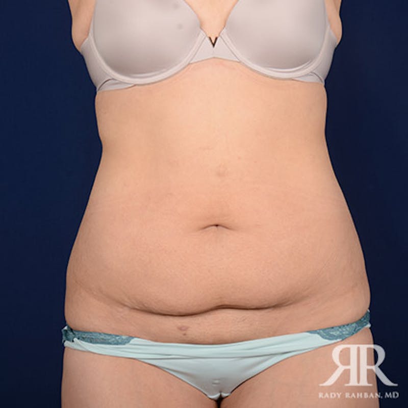 Body Lift Before & After Gallery - Patient 370415 - Image 1