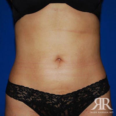 Liposuction Before & After Gallery - Patient 975469 - Image 2