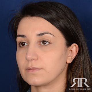 Female Rhinoplasty Before & After Gallery - Patient 140417 - Image 4