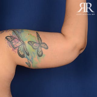 Arm Lift Before & After Gallery - Patient 702994 - Image 6