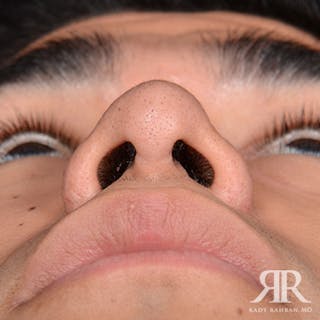 Ethnic Rhinoplasty Before & After Gallery - Patient 144472 - Image 8
