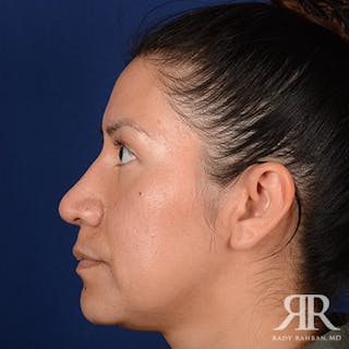Corrective / Revision Rhinoplasty Before & After Gallery - Patient 115295 - Image 6