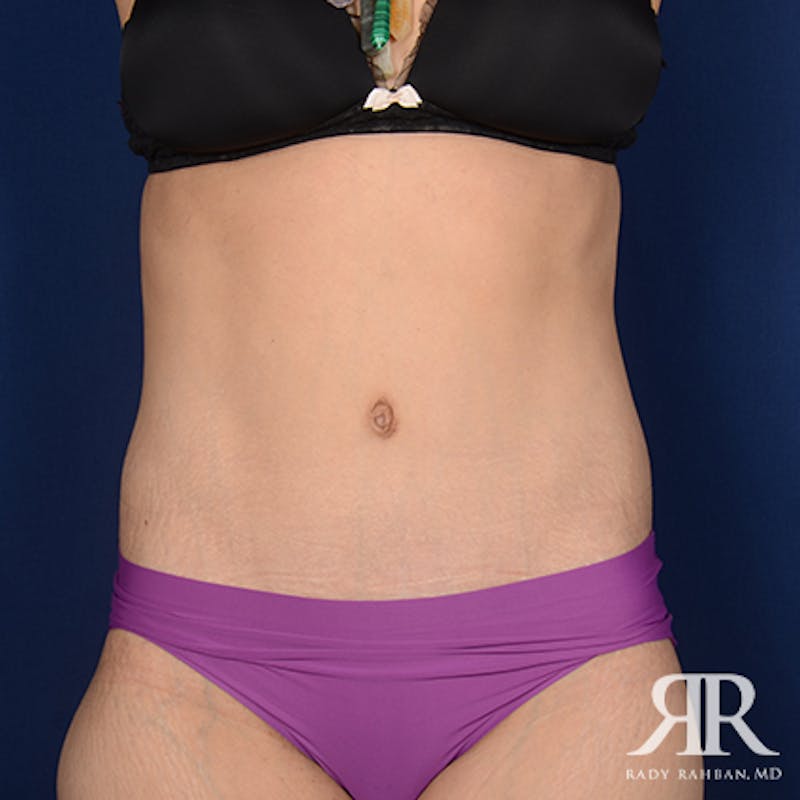Severe Diastasis Recti Before & After Gallery - Patient 274376 - Image 2