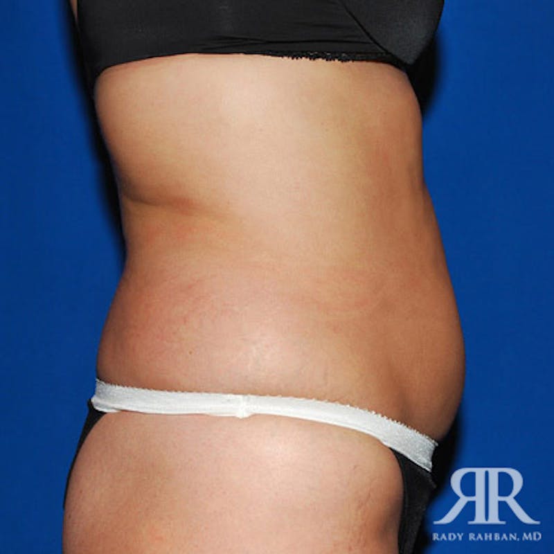 Liposuction Before & After Gallery - Patient 975469 - Image 3