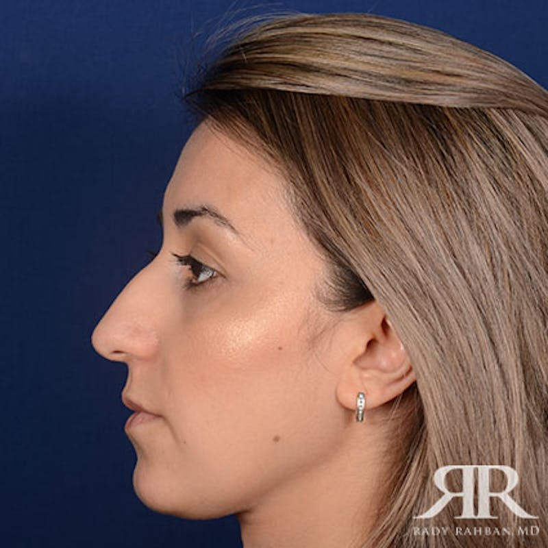 Female Rhinoplasty Before & After Gallery - Patient 140417 - Image 5
