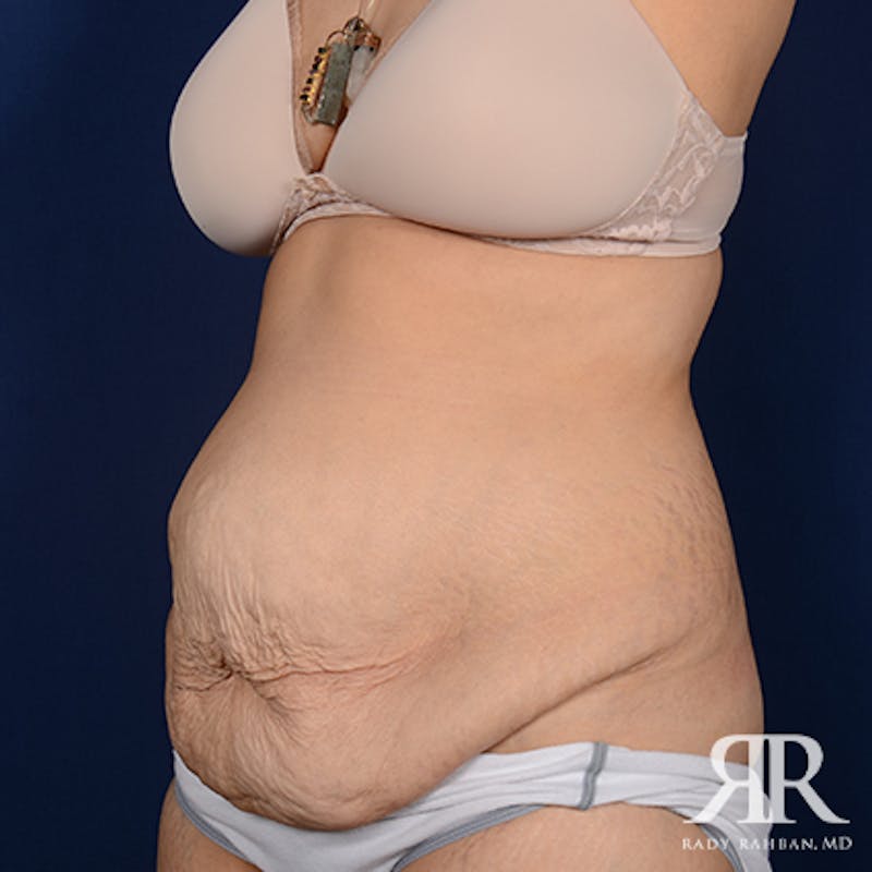 Severe Diastasis Recti Before & After Gallery - Patient 274376 - Image 3