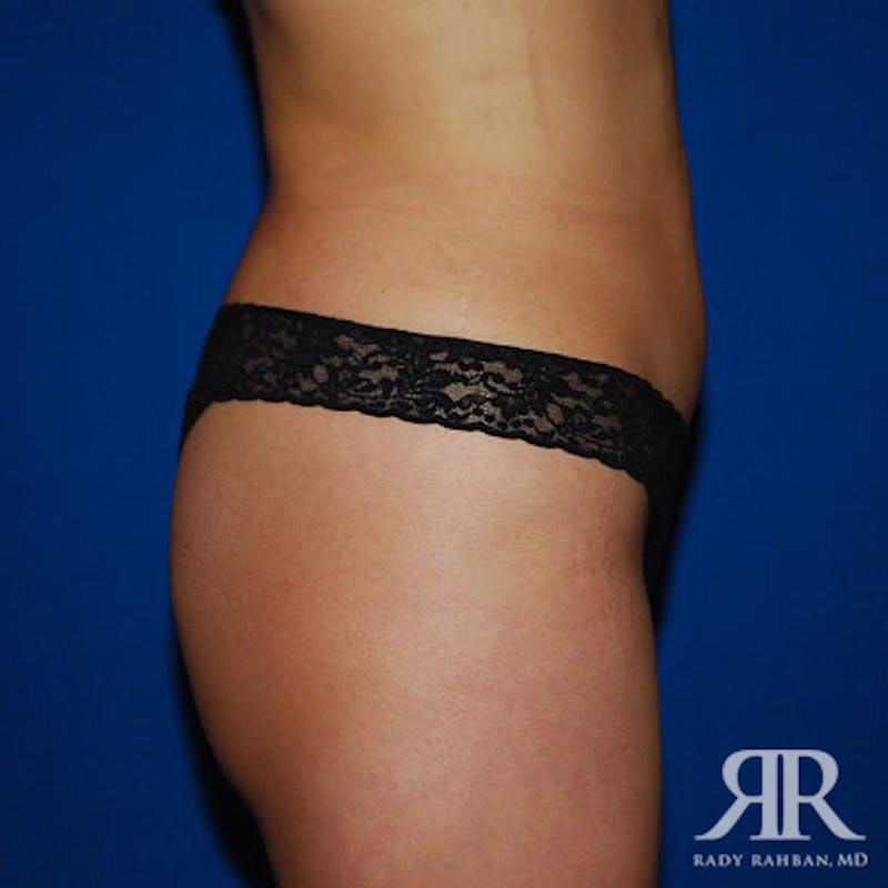 Liposuction Before & After Gallery - Patient 975469 - Image 4