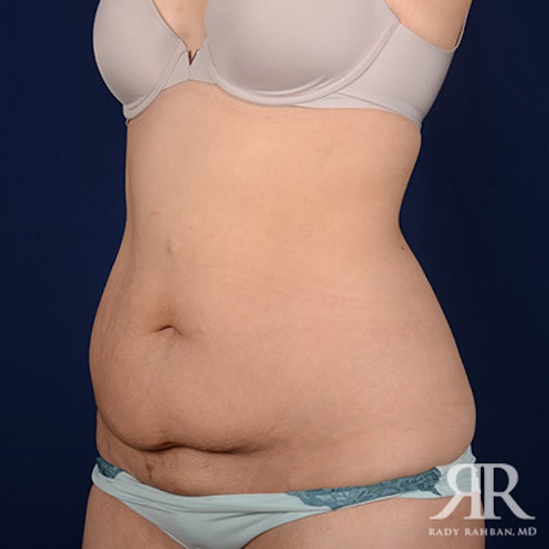 Body Lift Before & After Gallery - Patient 370415 - Image 3