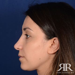 Female Rhinoplasty Before & After Gallery - Patient 140417 - Image 6
