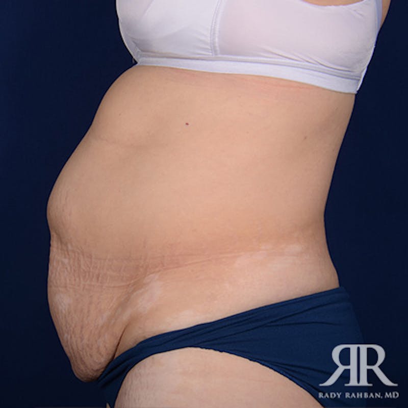 Tummy Tuck Before & After Gallery - Patient 406938 - Image 5