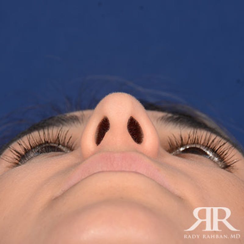 Female Rhinoplasty Before & After Gallery - Patient 140417 - Image 7