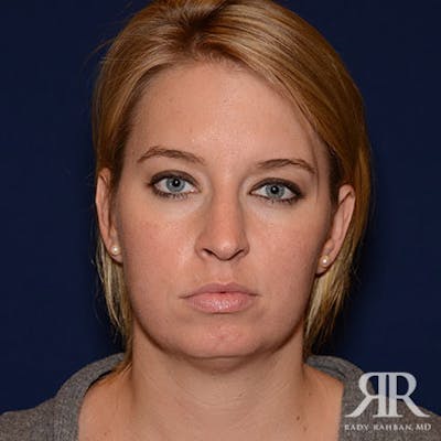 Chin Augmentation Before & After Gallery - Patient 310780 - Image 1