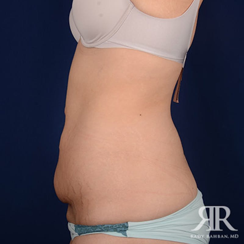 Body Lift Before & After Gallery - Patient 370415 - Image 5