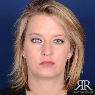 Chin Augmentation Before & After Gallery - Patient 310780 - Image 2